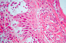 圖4：滲出液及大量炎症細胞與壞死細胞碎屑 沿著表皮形成痂皮。