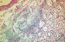 圖3：病豬大腸切片，黏膜呈纖維素性壞死性 病變，於黏膜下層可見炎症細胞浸潤、 纖維素及細胞碎片。(200×)