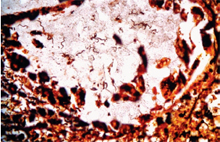 圖4：大腸切片之鍍銀染色。腺窩腔內可見螺 旋狀菌體。(1000×)