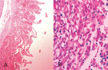 圖3：黏膜層排列混亂，淋巴管擴張，黏膜下 層水腫（圖A），大量巨噬細胞、嗜酸性 球、中性球與少量類上皮樣細胞浸潤於 黏膜層組織間（圖B）。