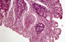 圖4：華氏囊淋巴濾泡局部壞死，淋巴細胞流 失，濾泡上皮細胞增生形成皺褶狀。