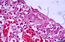 圖3：氣管粘膜上皮細胞腫大，圓形化，並可 見嗜酸性核內包涵體。