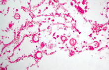 圖3：肺臟表面及實質可見多發壞死灶，部分 病灶於擴張的三級支氣管腔中可見分支 夾角45度且分節之黴菌菌絲，偶見太陽 花狀的分生孢子頭。(H & E；400 X)