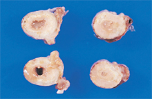 圖3：病雞盲腸腫大，腸壁增厚變硬，腸內容 物呈乾酪樣。