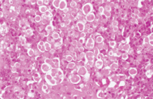 圖4：肝臟組織間隙可見大量嗜伊紅性圓形原 蟲蟲體及壞死肝臟細胞，病灶區周圍有 炎症細胞浸潤。（H & E 染色）