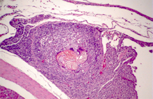 圖4：當蟲體死亡後類上內皮細胞所包圍形成 的肉芽腫。