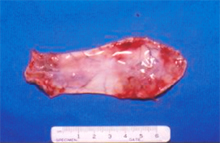 圖2：取下之肉芽腫組織。表面光滑，包被完 整。