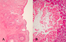 圖3：皮下膿瘍，內有mycetoma顆粒，(H&E, 40X)（圖A），顆粒內有黴菌厚壁孢子、 菌絲，外圍大量噬中性球，(H&E, 400X) （圖B）