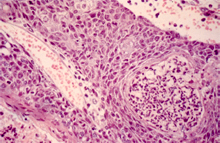 圖3： 鼠A於高倍下，棘狀層細胞鬆脫，顆粒 層、棘狀層間有細胞壞死碎屑及嗜中性 球為主的炎症細胞聚集，纖維化的現 象。