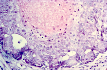 圖3：這些細胞最外層是多角型，非角質化的 細胞；中間層為較肥大，細胞質豐富， 細胞間橋（intercellular bridge）明顯的海 綿層（stratum spinosum）細胞，最終形 成扁平，死亡的角化細胞及堆積呈層板 狀的角質（keratin）及膿瘍。