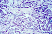 圖2：腺管樣腫瘤細胞呈乳頭樣生長，其間有 少量結締組織。
