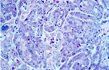 圖3：腫瘤細胞核呈圓形或卵圓形，含少量粉 紅色細胞質，細胞間界線不明顯，有絲 分裂旺盛。