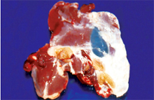圖1肝臟表面可見白色乾酪物附著