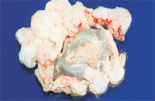 圖2：腸管表面可見白色乾酪物附著，並與腹 壁粘連。