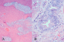 圖4：肝包膜炎、膽管周圍炎（圖A），膽管上 皮細胞明顯增生（圖B）。