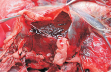 圖2：心囊內可見有大量暗紅色血液伴隨有大 量血凝塊蓄積。 