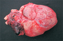 圖3：主動脈基部見一錐形，暗紅色、白色相 間，大小3x5公分之腫瘤結節。