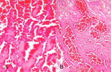 圖4：高倍下腫瘤細胞沿著粉紅均質樣無細胞 之stroma生長，腫瘤細胞之核呈圓形、梭 形至不整形，深染，細胞質大小不一， 而細胞界限不明顯（圖A），部分區域之 腫瘤細胞則呈團塊狀生長，且其內之腫 瘤細胞呈不規則之排列（圖B）。 