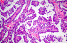 圖4：乳突樣分佈(Papillary pattern)：腫瘤細胞 依附於結締組織所形成的索(cord)排列呈 乳突樣。(H & E；400 X)
