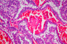 圖5：囊樣分佈(Cystic pattern)：腫瘤細胞形成 大小不一的囊樣結構，部分囊樣結構內 可見乳突樣生長之腫瘤團塊。(H & E； 100 X)