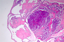 圖6：腫瘤細胞大小不一；細胞核呈空泡狀， 大小形狀不一，偶見有絲分裂；細胞質 量少。團塊中並可見出血之病灶。(H & E；400 X)