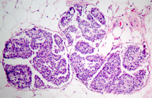 圖8：淋巴管可見腫瘤細胞所形成的栓子。(H & E；400 X)