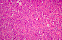 圖4：團塊型；腫瘤細胞聚集成團，細胞間界 線不清楚，沒有管樣結構及管腔形成。 (H & E，400×)