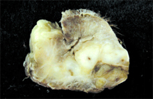 圖2：肛門左側團塊：和周圍組織界線不明， 觸感硬實，經福馬林固定後之切面顏色 呈白色，可見數個分葉結構。