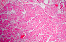 圖4：腫瘤團塊，低倍下內為乳突狀似腺管樣結構內含粉紅色均質物，外有結締組織包被。腫瘤細胞之細胞核大，形狀為圓到卵圓形，核質比大於一，有絲分裂相當明顯。