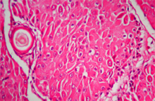 圖5：肛門右側團塊，腫瘤細胞為多角形，細 胞間界線清楚，核大而空泡，有多量呈 嗜酸性的細胞質，為典型之肝樣細胞， 於巢樣結構的周邊可見核濃染之嗜鹼性 細胞。(H & E；400 X)