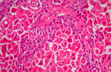 圖7：肛門左側團塊，嗜鹼性細胞數量增加而 呈多層排列，偶見有絲分裂。(H & E； 400 X)