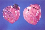 圖4：心室擴張內充滿凝血塊。血管怒張可見顯著白色虎斑狀條紋 (箭頭) 。